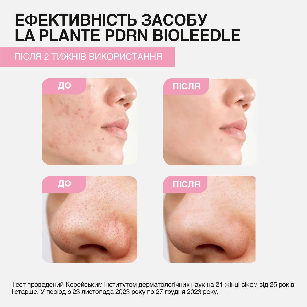 На фото показано ефективність використання сироватки LA PLANTE PDRN Bioleedle 100: результат "до" і "після" двох тижнів застосування, видно помітне зменшення акне на обличчі.
