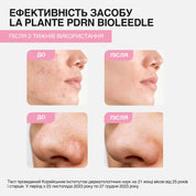 На фото показано ефективність використання сироватки LA PLANTE PDRN Bioleedle 100: результат "до" і "після" двох тижнів застосування, видно помітне зменшення акне на обличчі.